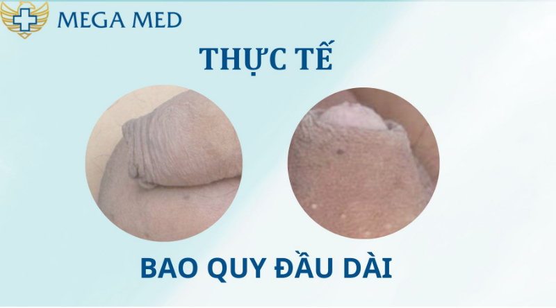 Hình ảnh trường hợp cắt bao quy đầu dài 